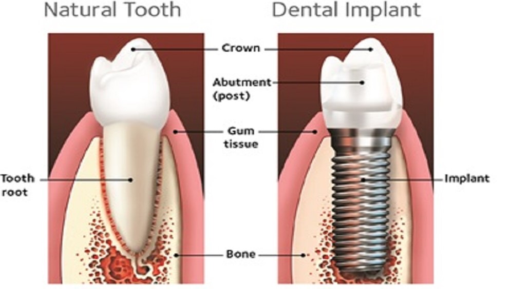 Dental Implant.jpg